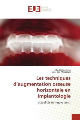 Les techniques d'augmentation osseuse horizontale en implantologie