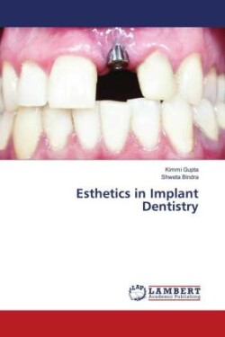 Esthetics in Implant Dentistry