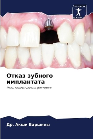 Отказ зубного имплантата