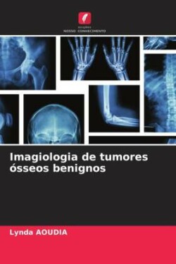 Imagiologia de tumores ósseos benignos