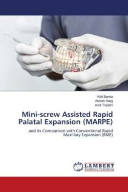 Mini-screw Assisted Rapid Palatal Expansion (MARPE)