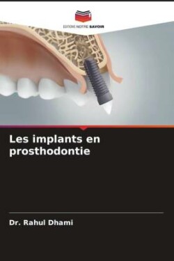 Les implants en prosthodontie
