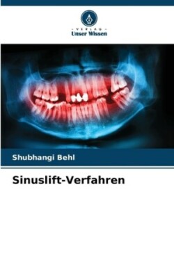 Sinuslift-Verfahren