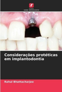 Considerações protéticas em implantodontia