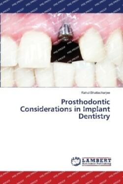 Prosthodontic Considerations in Implant Dentistry