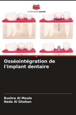 Osséointégration de l'implant dentaire