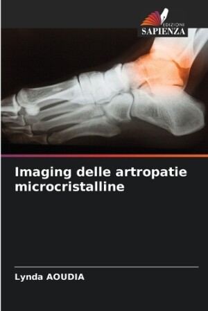 Imaging delle artropatie microcristalline