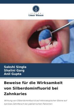 Beweise für die Wirksamkeit von Silberdominfluorid bei Zahnkaries