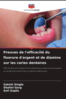 Preuves de l'efficacité du fluorure d'argent et de diamine sur les caries dentaires