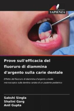 Prove sull'efficacia del fluoruro di diammina d'argento sulla carie dentale