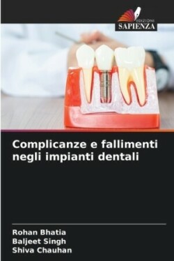 Complicanze e fallimenti negli impianti dentali