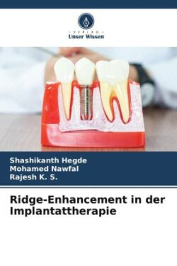 Ridge-Enhancement in der Implantattherapie