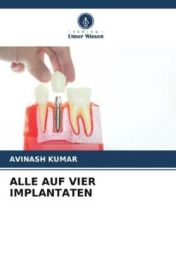 ALLE AUF VIER IMPLANTATEN