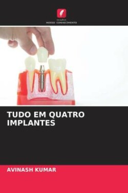 TUDO EM QUATRO IMPLANTES