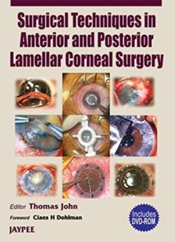 Surgical Techniques in Anterior and Posterior Lamellar Corneal Surgery