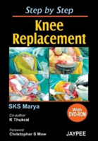 Step by Step Knee Replacement