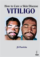 How to Cure a Skin Disease: Vitiligo
