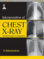 Interpretation of Chest X-Ray