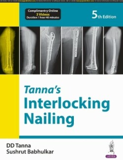 Tanna’s Interlocking Nailing